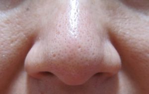  【フィトリフトホットクレンジングジェル】40代毛穴の汚れや角栓落とし　口コミレビュー　ホットクレンジングを使う前の自分の鼻の毛穴の画像